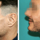Illustration for article titled Some Facts About The Beard Transplant